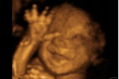 ultrasound3d13b.png