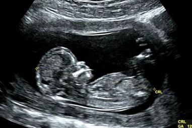 ultrasound3d56.jpg